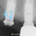 cracked-dental-implant-broken-tooth-arrows-indicating-break-ct-scan-featured