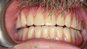 healing-dentures-all-on-x-after-featured